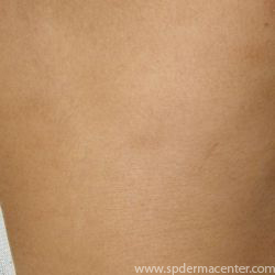 Vitiligo-After